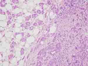 Tumour acini infiltrating perinodal fat