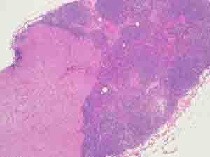 Low power view of replacement matastasis - extension into perinodal fat can be seen at this magnification.