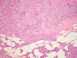 Medium power view showing infitration of perinodal fat by metastatic carcinoma.